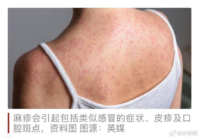 倫敦多所學校暴發“快速傳播”麻疹疫情，數十人感染