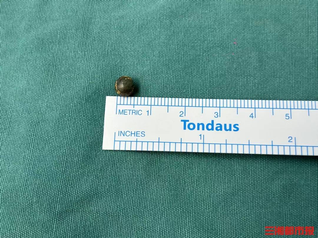 男童被射釘槍誤傷，“黑科技”助醫生完成顱內毫米級手術